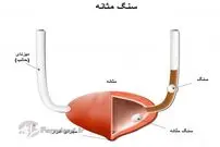 راه‌های تشخیص و درمان سنگ مثانه
