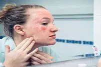 مقابله با اگزمای زمستانی
