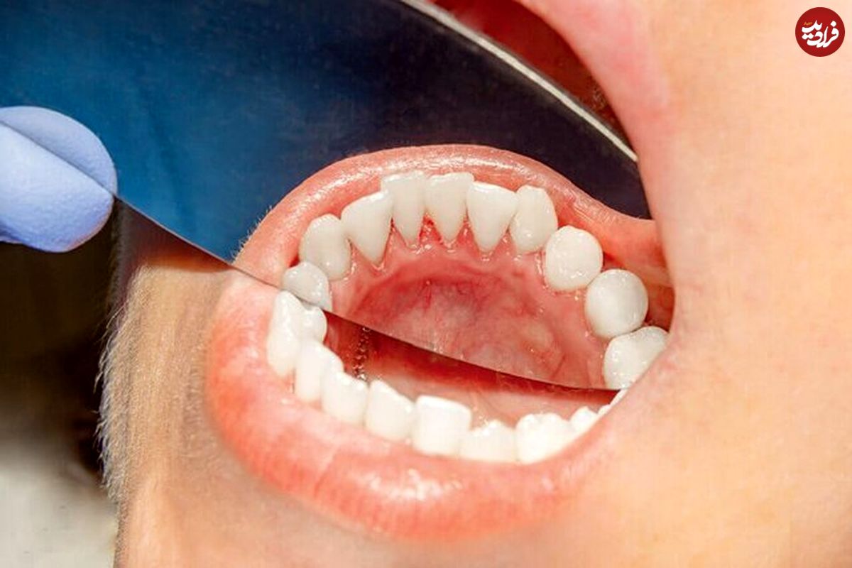 علائم شایع سرطان دهان