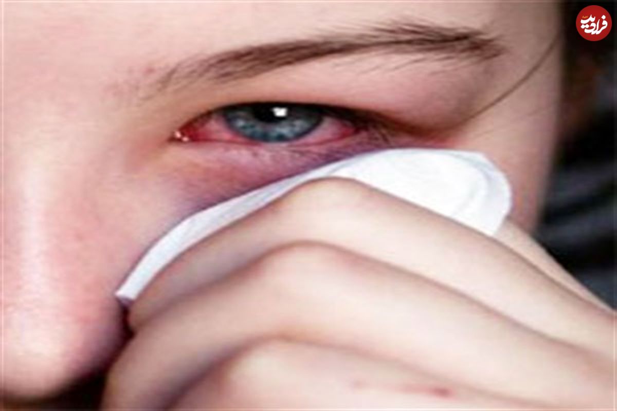 هشدار نسبت به عوارض استفاده از لنزهای اجاره ای