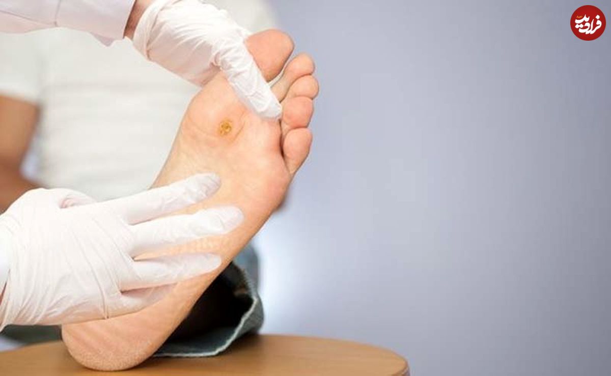 دیابتی‌ها چطور مراقب سلامت پا‌های خود باشند؟