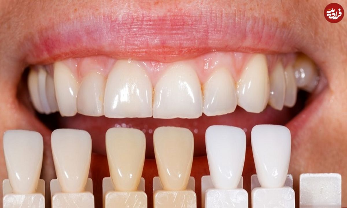 فرمول غذایی برای سفید کردن دندان‌ها