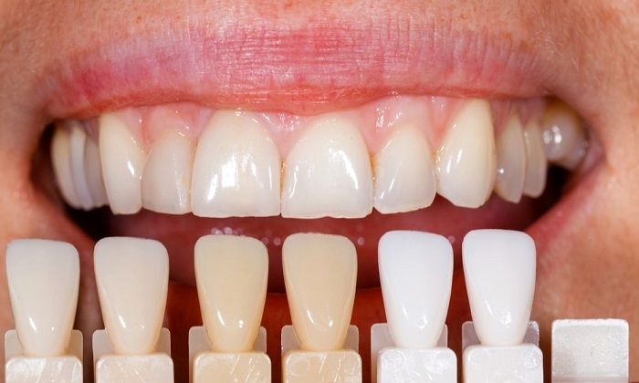 فرمول غذایی برای سفید کردن دندان‌ها