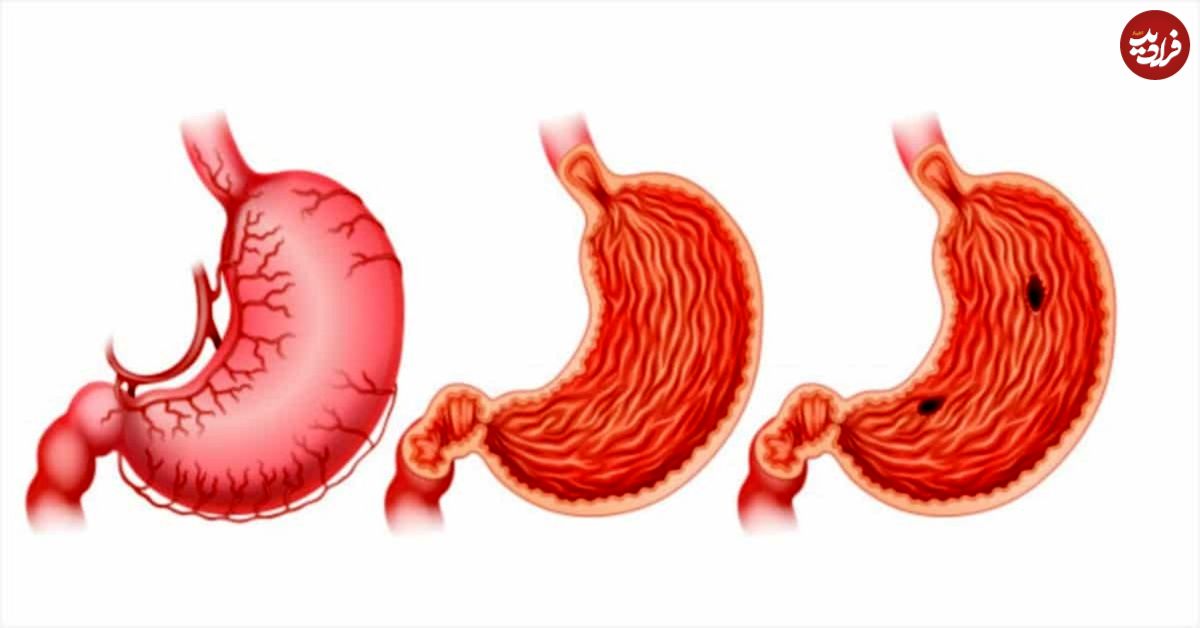 چرا زخم معده میگیریم؟