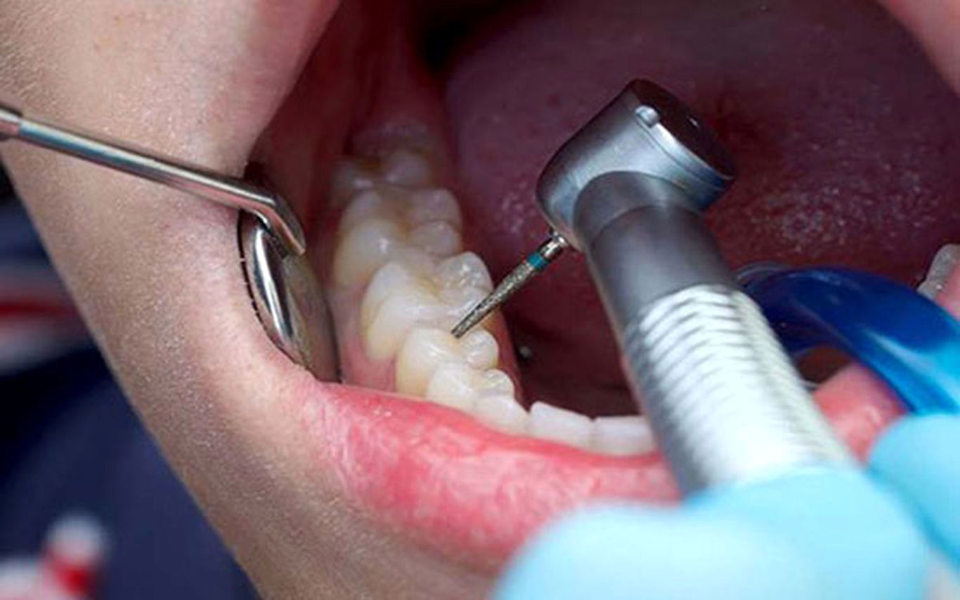دندان‌ها پس از عصب کشی چه مدت دوام می‌آورند؟
