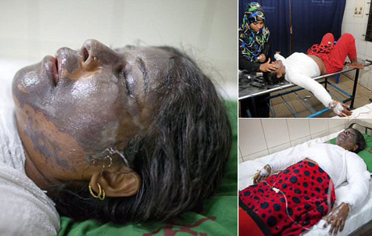 عکس/ شوهر چهره زنش را به‌خاطر جهیزیه سوزاند