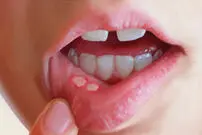 روشی برای بهبود آفت‌های دهان