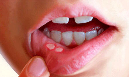 روشی برای بهبود آفت‌های دهان