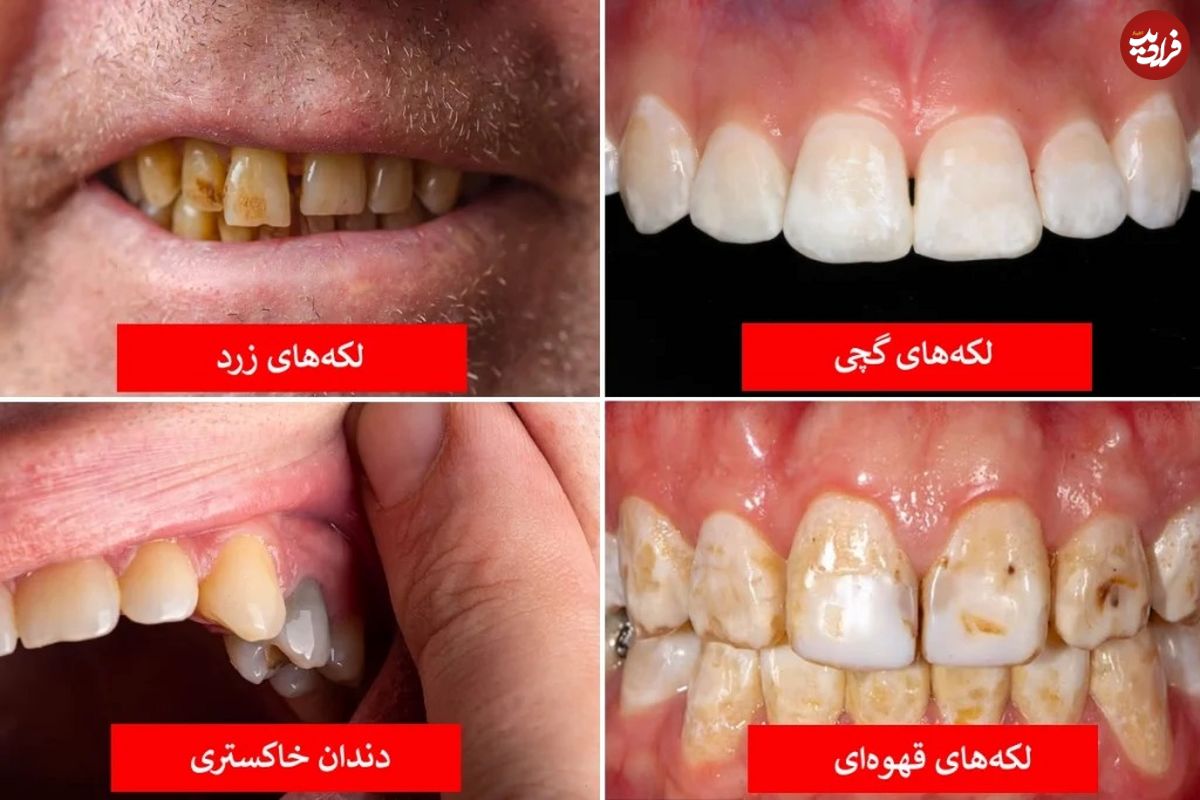 تصاویر؛ رنگ دندان از دیدگاه علم چه چیزهایی درباره سلامت شما می‌گوید؟
