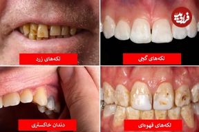 تصاویر؛ رنگ دندان از دیدگاه علم چه چیزهایی درباره سلامت شما می‌گوید؟