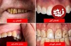 تصاویر؛ رنگ دندان از دیدگاه علم چه چیزهایی درباره سلامت شما می‌گوید؟