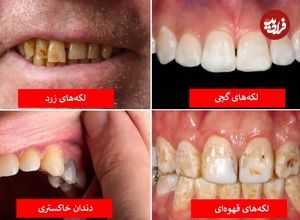 تصاویر؛ رنگ دندان از دیدگاه علم چه چیزهایی درباره سلامت شما می‌گوید؟