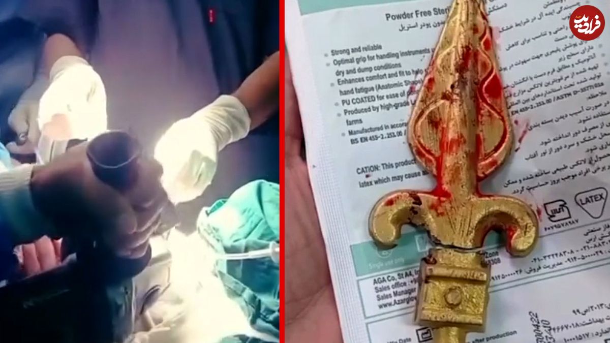 ببینید؛ خارج کردن نیزه فلزی از دهان کودک ۱۱ ساله در ایرانشهر