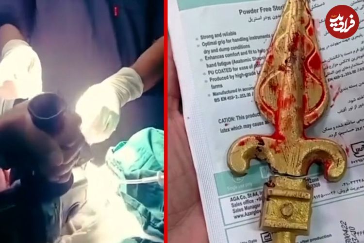 ببینید؛ خارج کردن نیزه فلزی از دهان کودک ۱۱ ساله در ایرانشهر