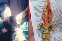 ببینید؛ خارج کردن نیزه فلزی از دهان کودک ۱۱ ساله در ایرانشهر