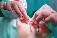 چه افرادی نباید بینی خود را عمل کنند؟