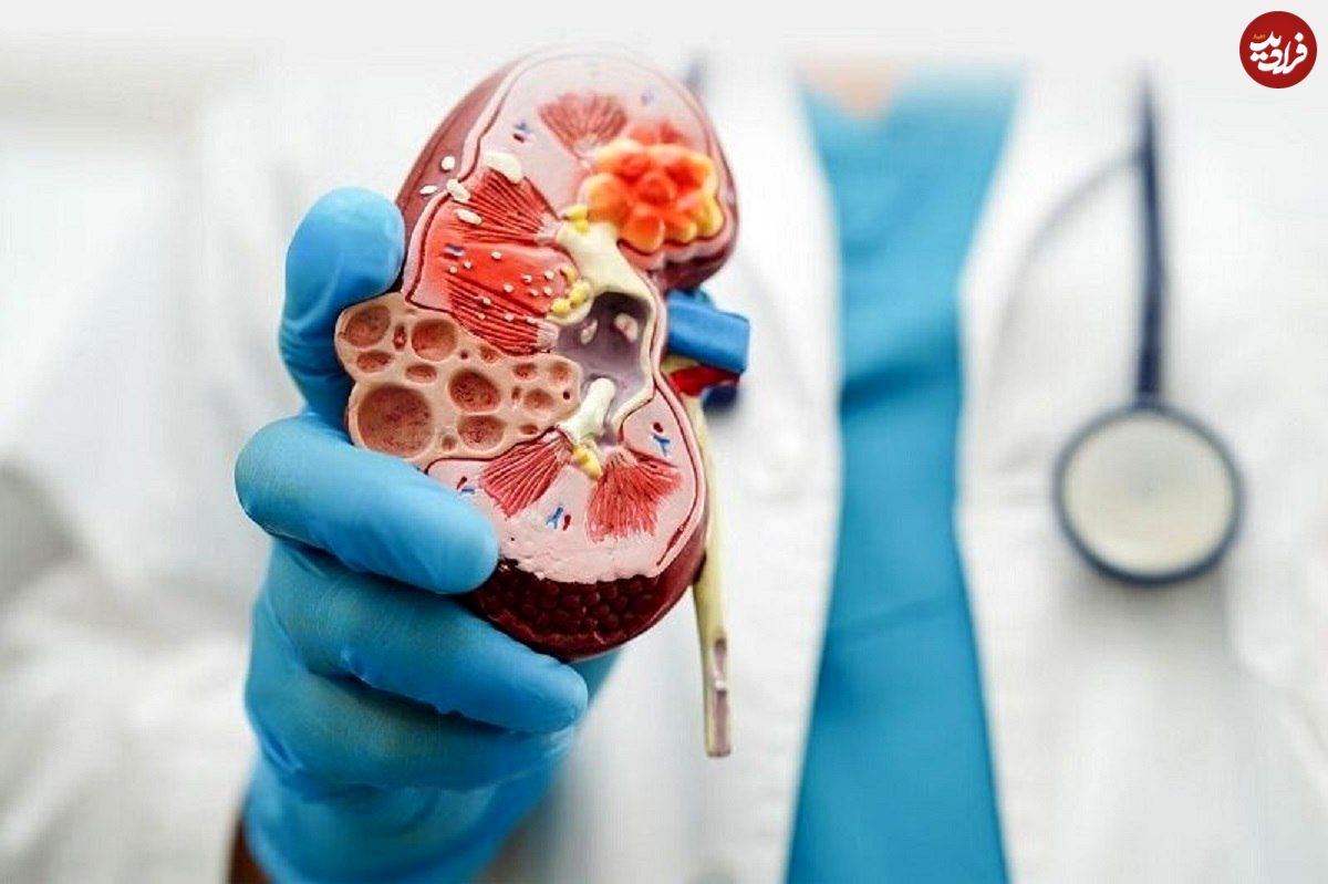 سه بیماری خاص که کلیه‌ها را از کار می‌اندازد