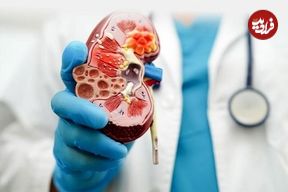 سه بیماری خاص که کلیه‌ها را از کار می‌اندازد