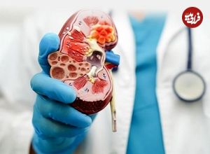 سه بیماری خاص که کلیه‌ها را از کار می‌اندازد