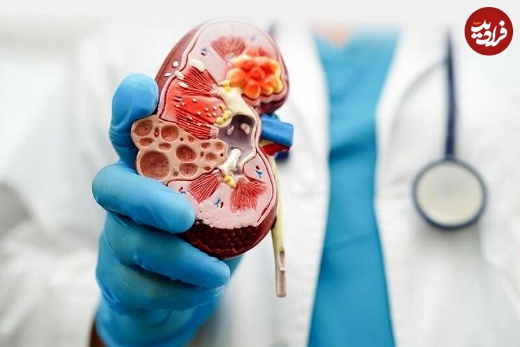 سه بیماری خاص که کلیه‌ها را از کار می‌اندازد