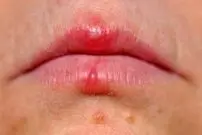 اشتباه مهلک در تشخیص آفت و تب‌خال؛ کدام‌یک مسری و خطرناک است؟