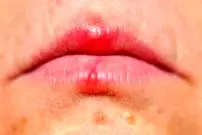 اشتباه مهلک در تشخیص آفت و تب‌خال؛ کدام‌یک مسری و خطرناک است؟