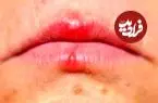اشتباه مهلک در تشخیص آفت و تب‌خال؛ کدام‌یک مسری و خطرناک است؟