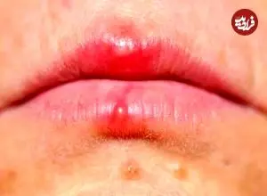 اشتباه مهلک در تشخیص آفت و تب‌خال؛ کدام‌یک مسری و خطرناک است؟