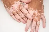کمبود چه ویتامینی باعث پیسی می‌شود؟ 