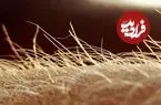 خارش احتمالا اندام حسی مخصوص به خود را دارد