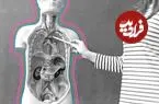 آیا می‌توان بدون روده بزرگ زندگی کرد؟