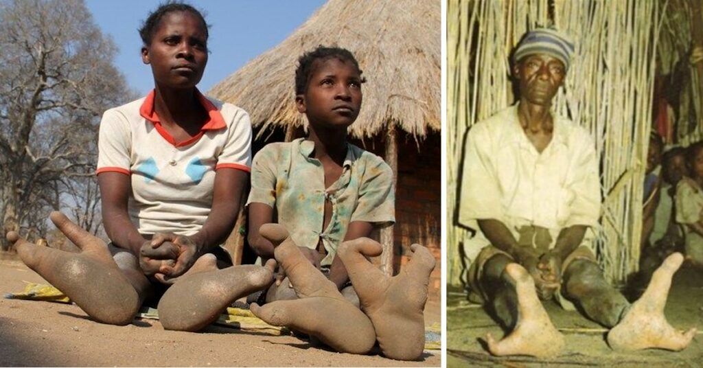(عکس) قبیله آفریقایی با پاهای شترمرغی: چرا مردم «وادوما» فقط دو انگشت پا دارند؟