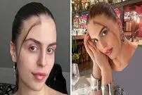 (تصاویر) مدل شدن دختری که با یک دسته مو در وسط پیشانی اش متولد شده است