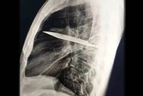 عکس؛ کشف عجیب در قفسه سینه؛ چاقویی که ۸ سال در بدن مردی جا خوش کرده بود