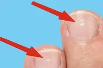 (عکس) لکه های سفید روی ناخن ها چه معنایی دارند؟