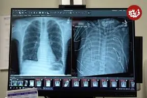 مردی ۴۸ ساعت بدون ریه زنده ماند