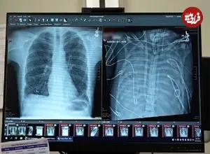 مردی ۴۸ ساعت بدون ریه زنده ماند