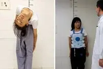 (تصاویر) مورد عجیب زنی با ستون فقرات ۱۸۰ درجه خم شده و سر به کمر چسبیده!
