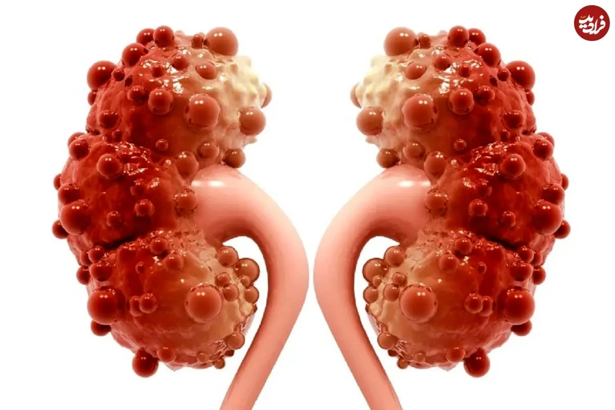 چرا کیست کورتیکال کلیه ایجاد می‌شود و چه زمانی خطرناک است؟