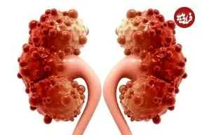 چرا کیست کورتیکال کلیه ایجاد می‌شود و چه زمانی خطرناک است؟