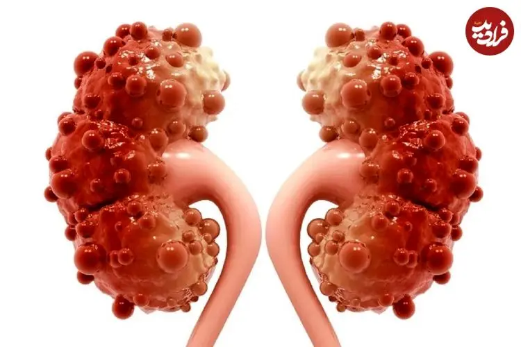 چرا کیست کورتیکال کلیه ایجاد می‌شود و چه زمانی خطرناک است؟