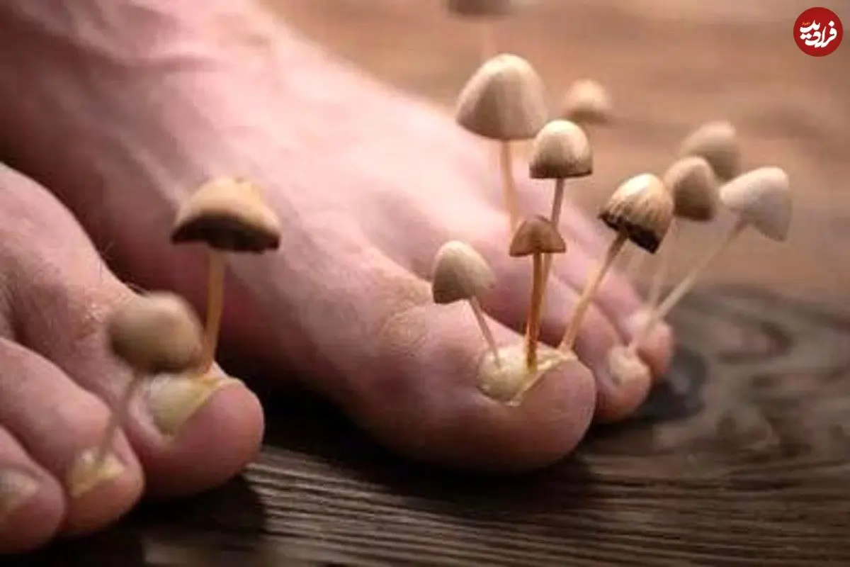 تخم‌مرغ گندیده؛ از بین برنده قارچ‌های ناخن!