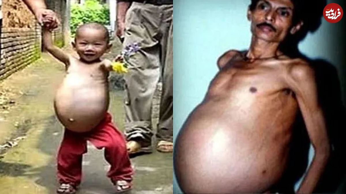 (عکس) مرد هندی ۳۶ سال از بارداری اش بی خبر بود!