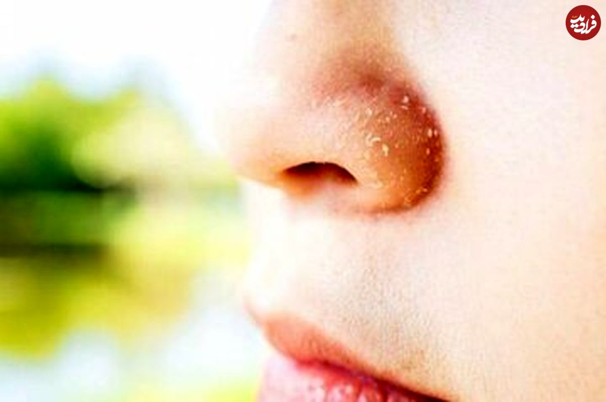 علت پوسته پوسته شدن روی بینی چیست؟