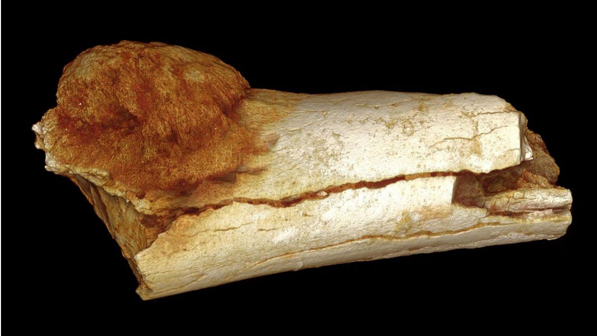 قدیمی‌ترین مورد «سرطان» کشف شد؛ ۱ میلیون و ۷۰۰ هزار سال قبل!