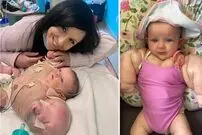 هالک کوچولو؛ نوزادی که با دست و بالاتنه ای بزرگ متولد شد