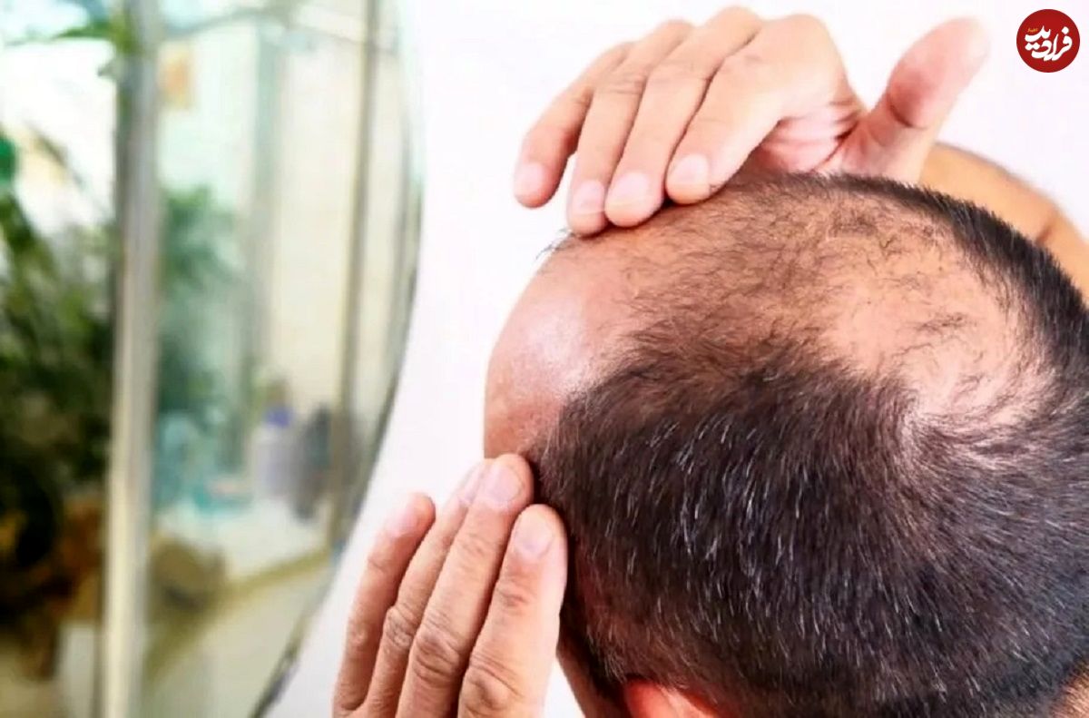 کشف تصادفی درمان طاسی؛ این قند طبیعی میتواند باعث رشد مجدد مو شود