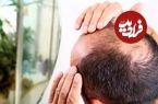 کشف تصادفی درمان طاسی؛ این قند طبیعی می‌تواند باعث رشد مجدد مو ‌شود