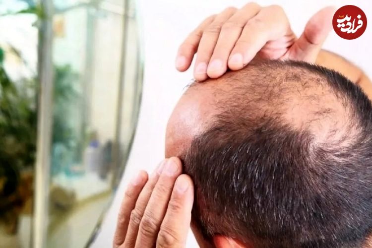 کشف تصادفی درمان طاسی؛ این قند طبیعی می‌تواند باعث رشد مجدد مو ‌شود