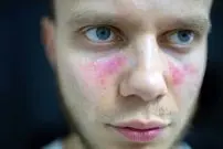 درباره لوپوس و سایر بیماری‌های خودایمنی